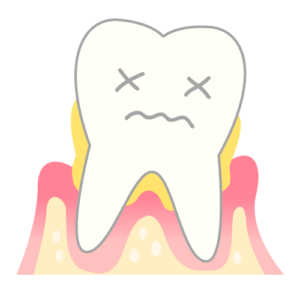 歯科治療中断による口内環境の悪化。イメージ